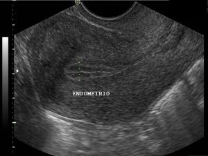 ultrassom ginecológico