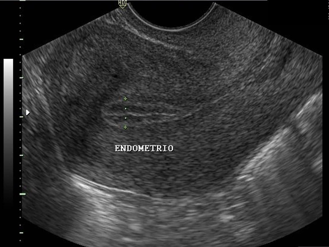 Ultrassom Ginecol Gico Diagnosis Centro De Diagn Stico Por Imagem Ribeir O Preto